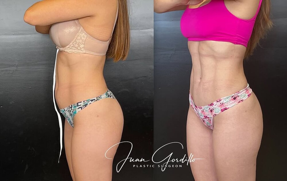 Before and After Result